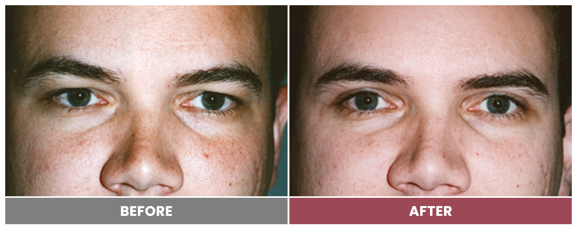 Upper Blepharoplasty - Case 19